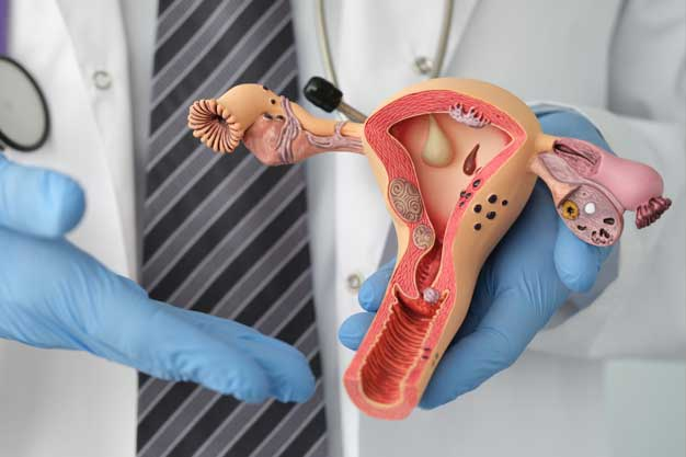 Imagem ilustrativa de maquete que representa ocolo curto e incompétencia Istmocervical.